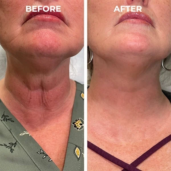 Botox Face Serum - Image 4