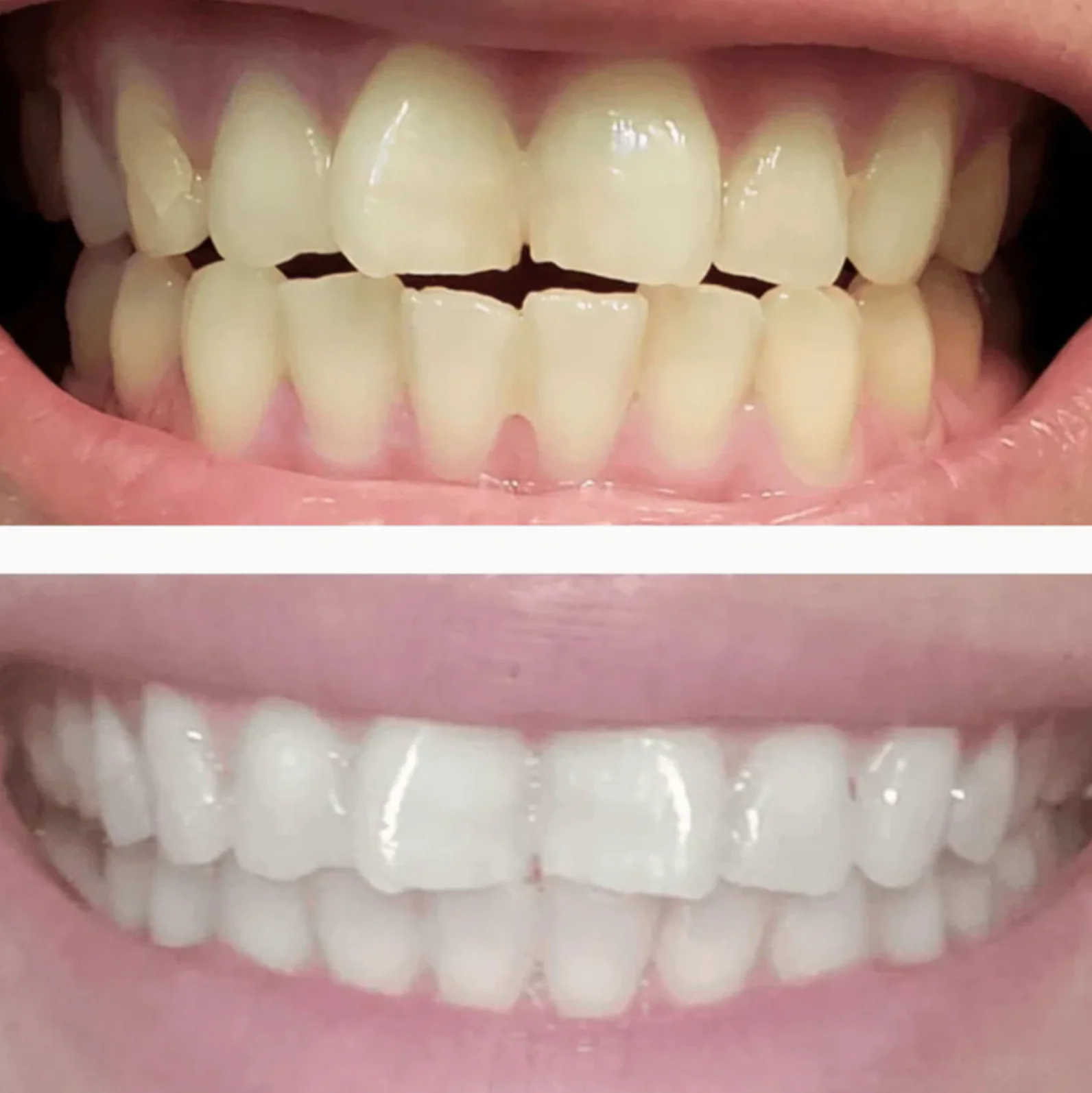 DiamondSeries® Teeth Whitening Serum Pen - Image 4