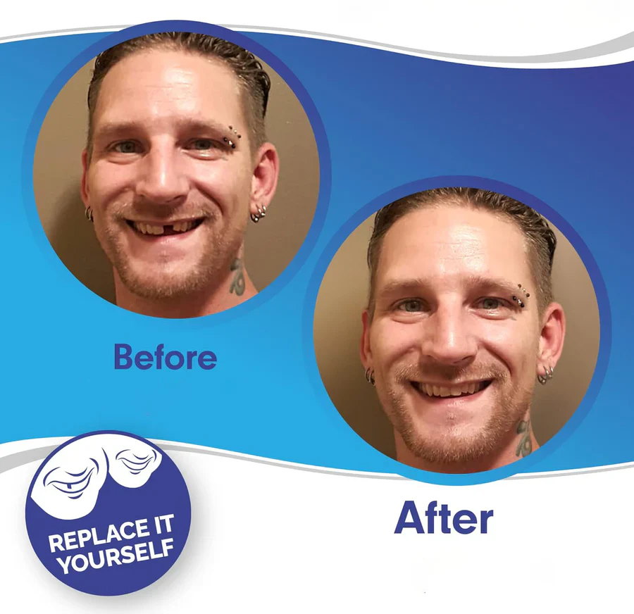 Smile Veneer (Upper & Lower Included) - Image 3