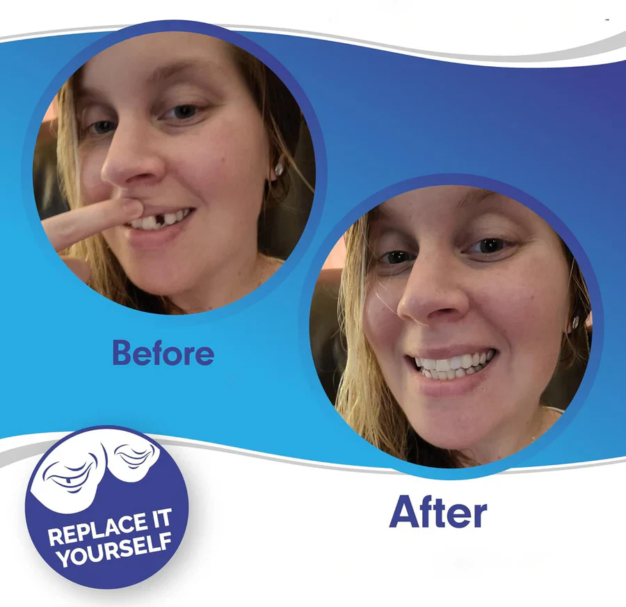 Smile Veneer (Upper & Lower Included) - Image 4
