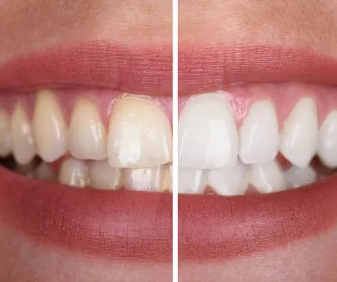 Whitening Teeth Paint - Image 2